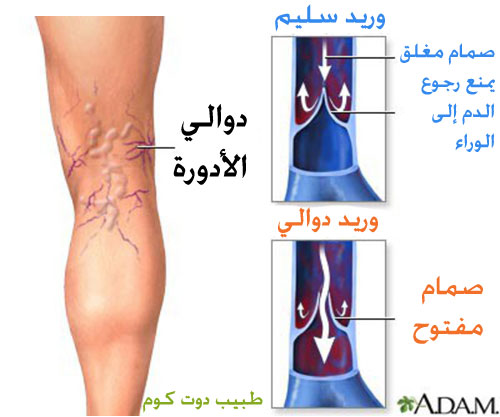 دوالي الأوردة